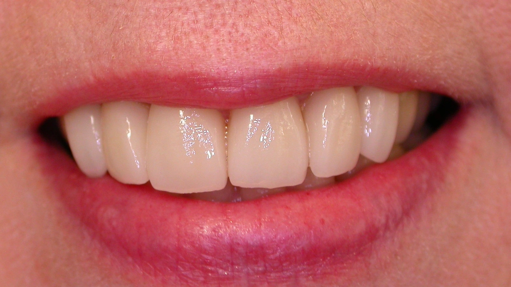 reshaped uniform smile after dental contouring