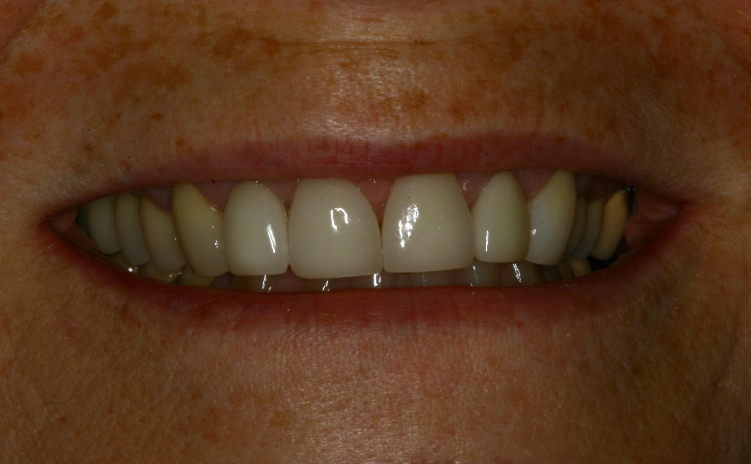 seamlessly repaired tooth after care treatment