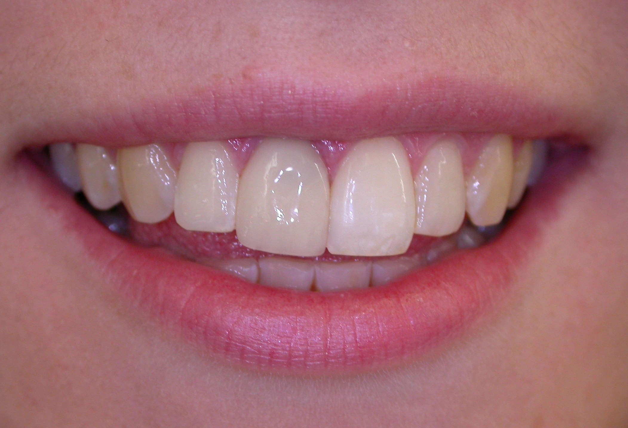 severe tooth wear before rehabilitation treatment