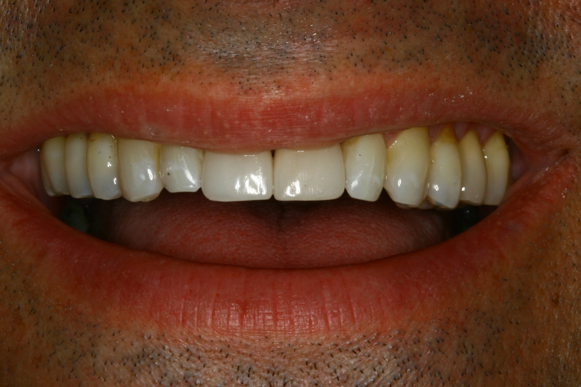 symmetrical smile after cosmetic treatment
