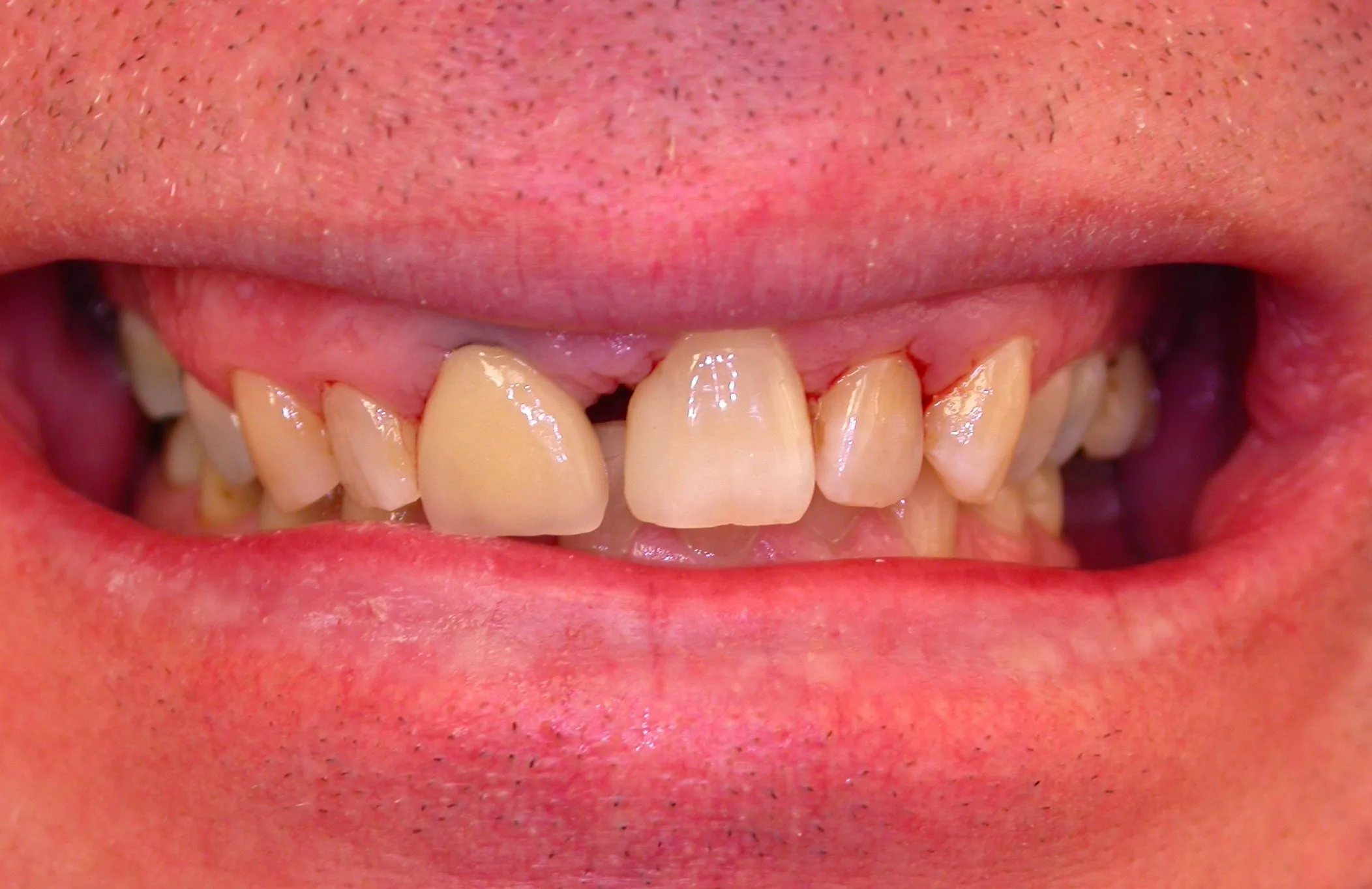 tooth spacing gaps before orthodontic treatment