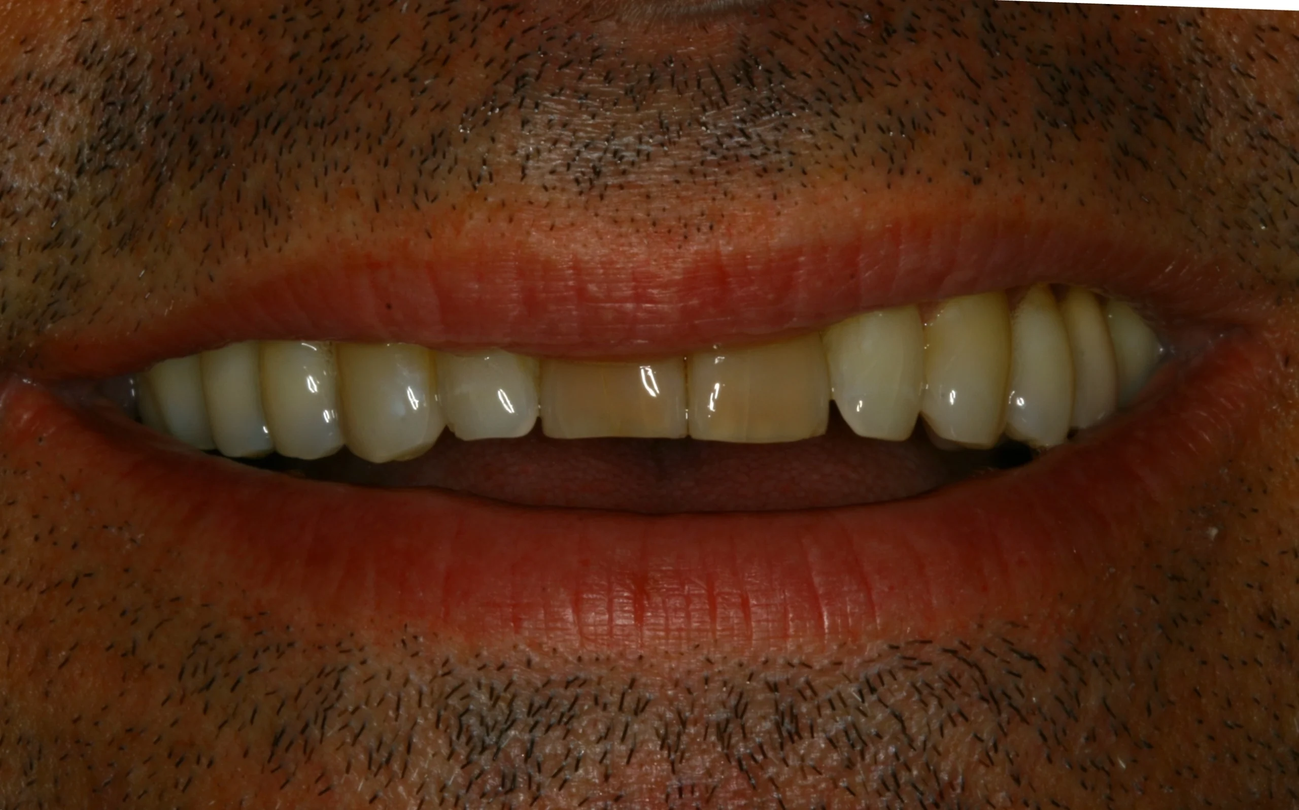 uneven gumline before cosmetic treatment