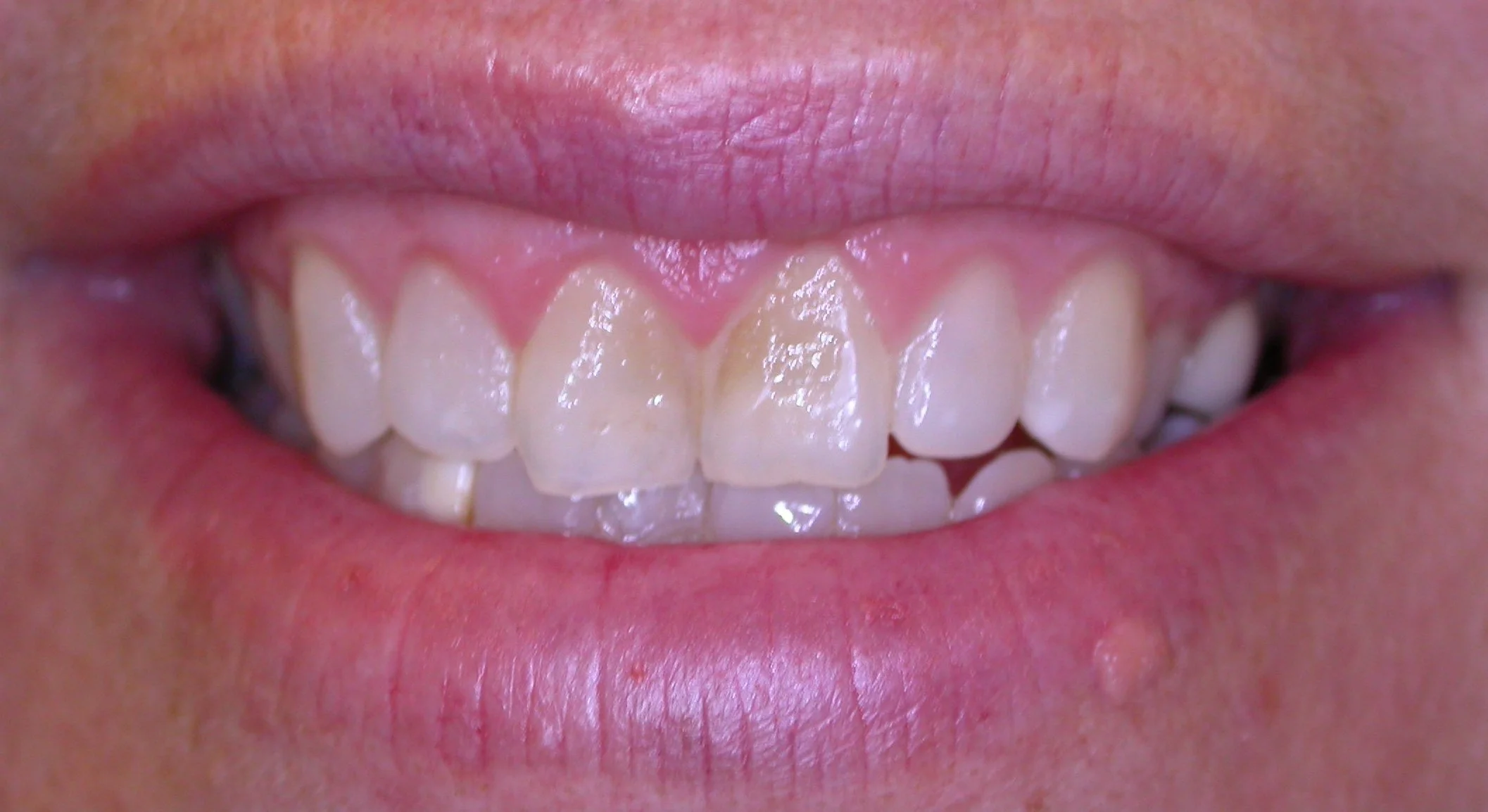 visible dental damage before clinical treatment