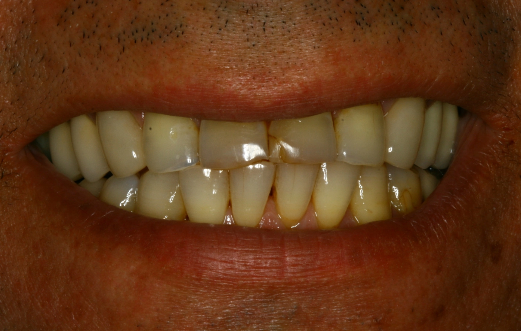 worn down teeth before veneer treatment