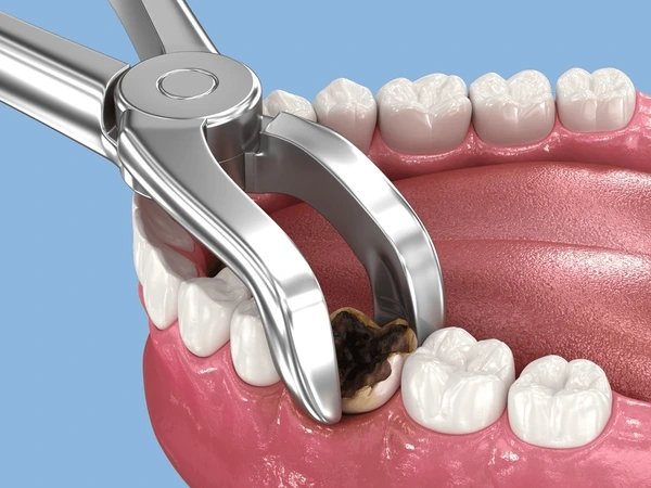 tooth extractions near you