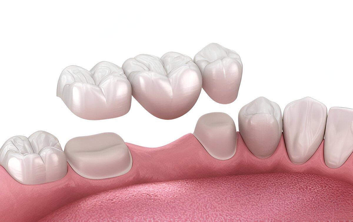 dental bridges in wetaskiwin ab