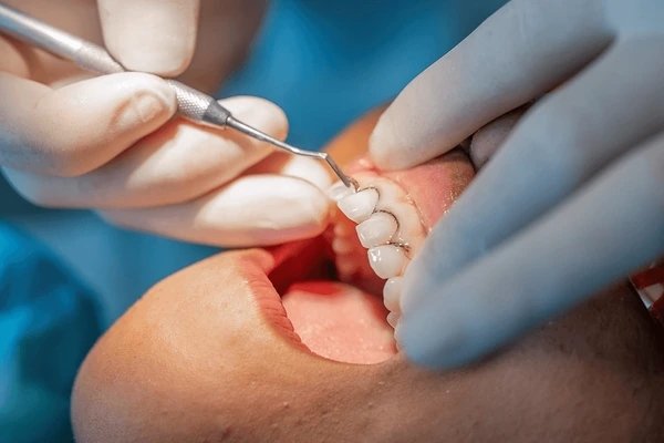 dental crowns in wetaskiwin ab