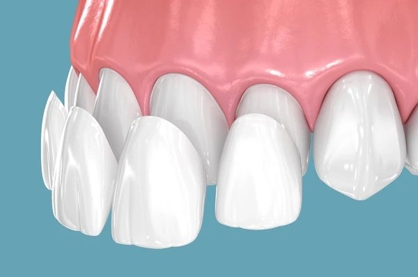 porcelain veneers near you