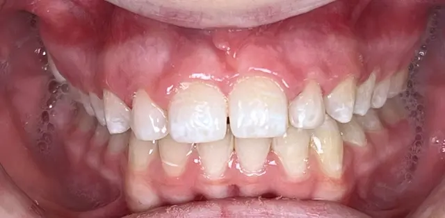 bright white smile after whitening treatment