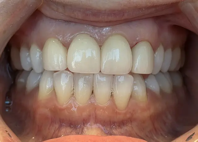 bright white smile after whitening treatment