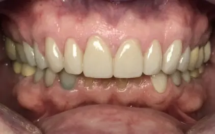 bright white smile after whitening treatment