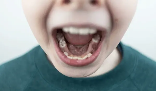 baby teeth start falling out
