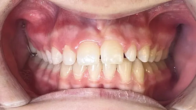 yellow stained teeth before whitening treatment