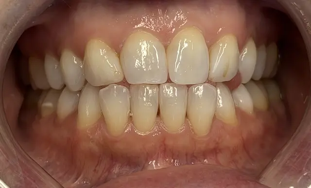 yellow stained teeth before whitening treatment