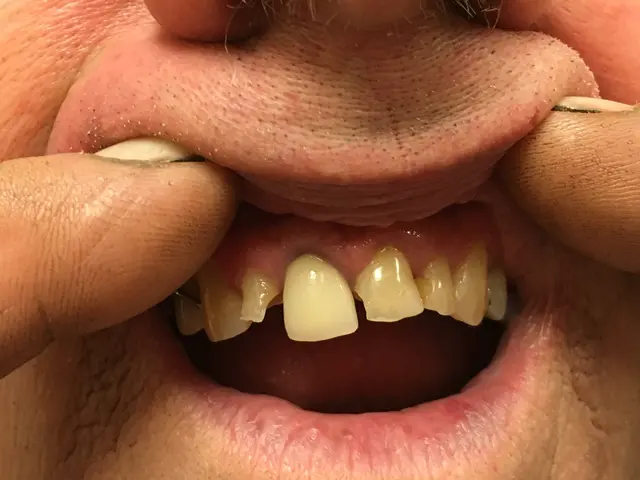 yellow stained teeth before whitening treatment