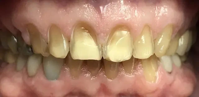 yellow stained teeth before whitening treatment