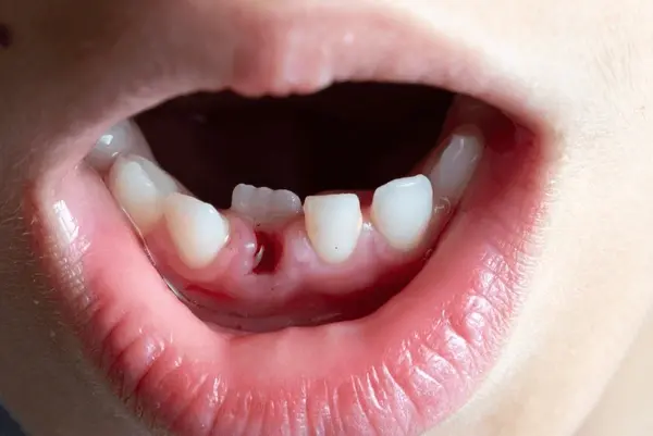 childs smile showing space for upcoming permanent teeth