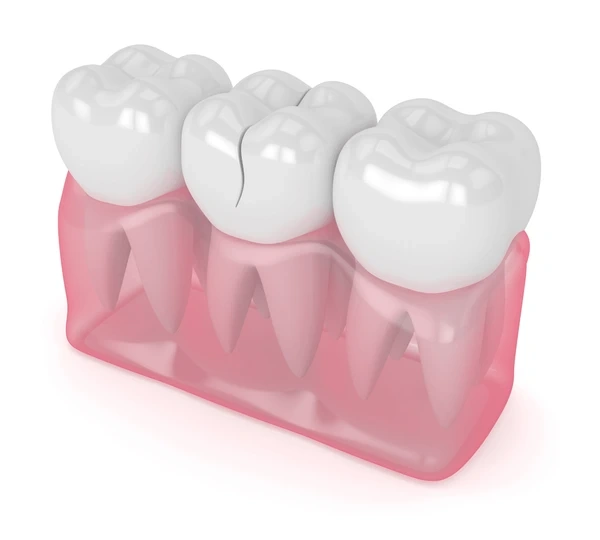 cracked tooth treatment near you