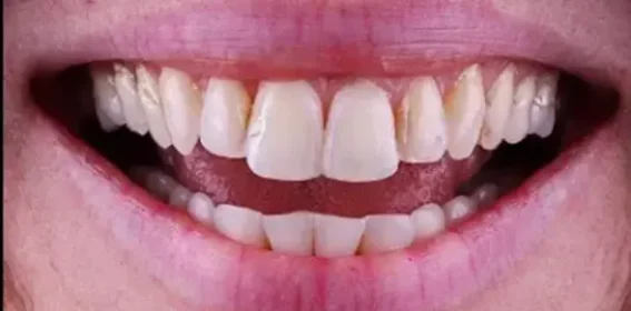 dental alignment issues before treatment