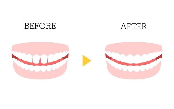 dental bonding in minneapolis mn