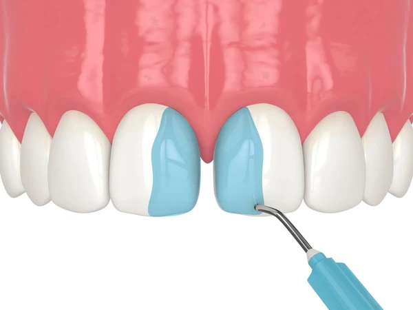 dental bonding near you