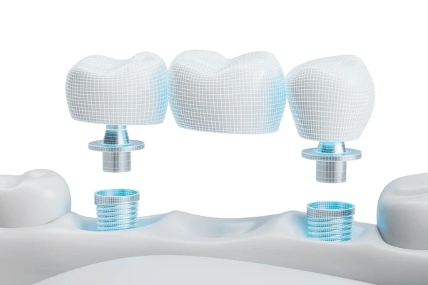 dental bridges near you