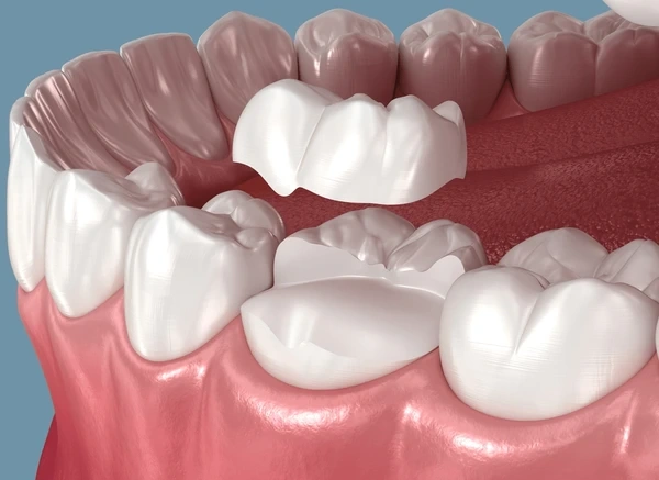dental inlays onlays in minneapolis mn