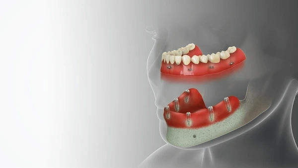 full mouth restoration in minneapolis mn