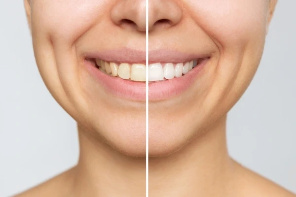 teeth whitening near you
