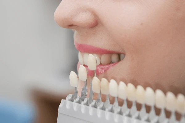 tooth colored fillings in minneapolis mn