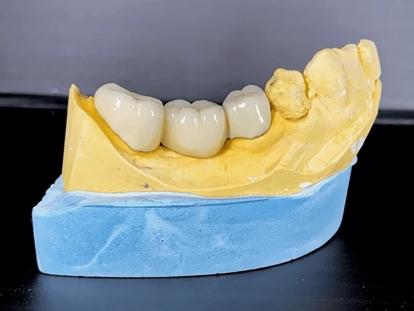 dental bridges in downtown toronto on