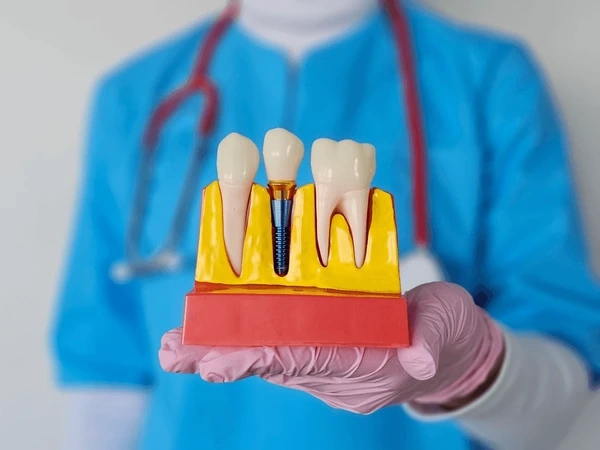 dental implants near you