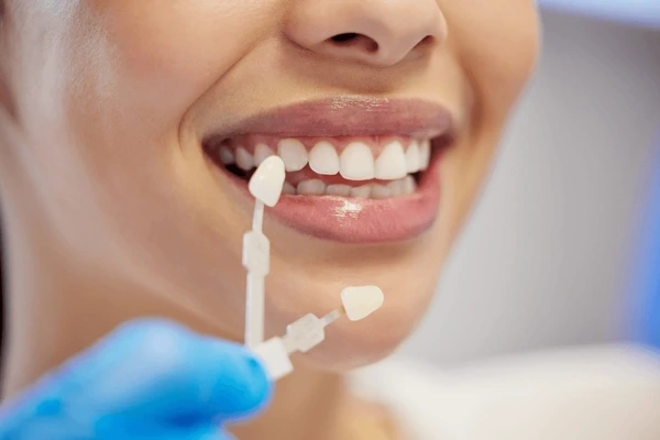 dental veneers near you