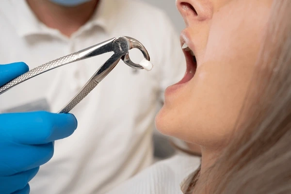 wisdom tooth extraction in downtown toronto on