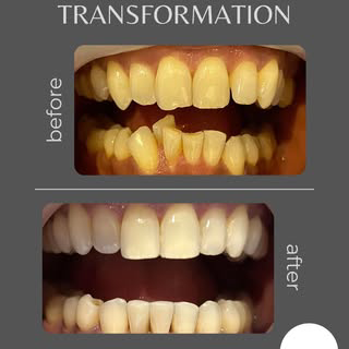 dental transformation before and after cosmetic work